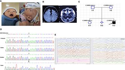 Homozygous PIGT Mutation Lead to Multiple Congenital Anomalies-Hypotonia Seizures Syndrome 3